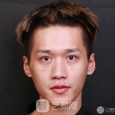 重慶軍美胡金香鼻部手術(shù)六個(gè)月了，分享恢復(fù)果~